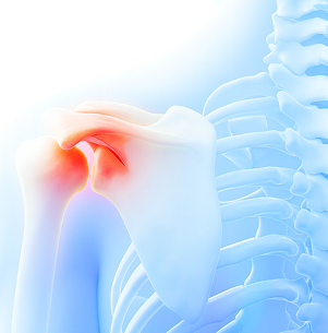 어깨에 발생하는 대표적인 질환 이미지