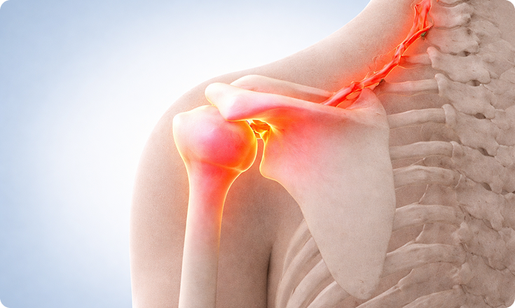 근본정형외과의원 어깨 질환의 주요원인