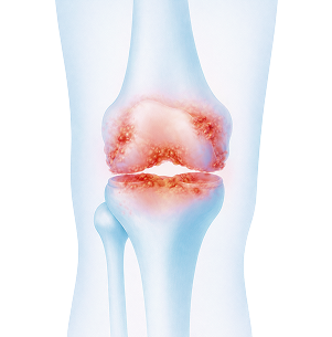 무릎에 발생하는 대표적인 질환 이미지
