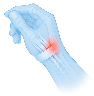 상지에 발생하는 대표적인 질환 이미지
